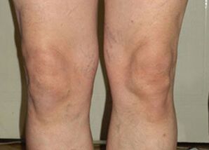 Pas një kursi të përdorimit të Osteflex, nyjet kthehen në normalitet